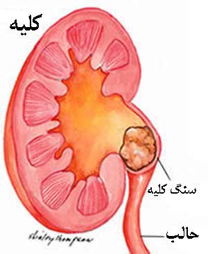 http://ylym.files.wordpress.com/2008/07/kidney-stone.jpg